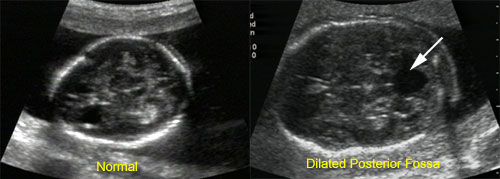 Genetic Sonography: Routine Ultrasound