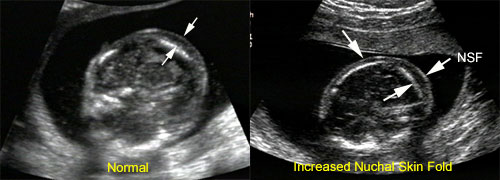 Genetic Sonography: Routine Ultrasound